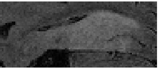 Ambiguous MRI