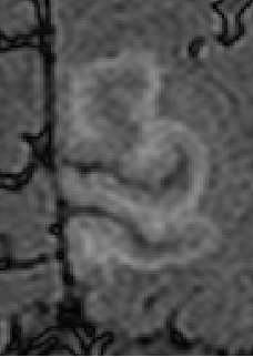 Complexly Shaped MRI